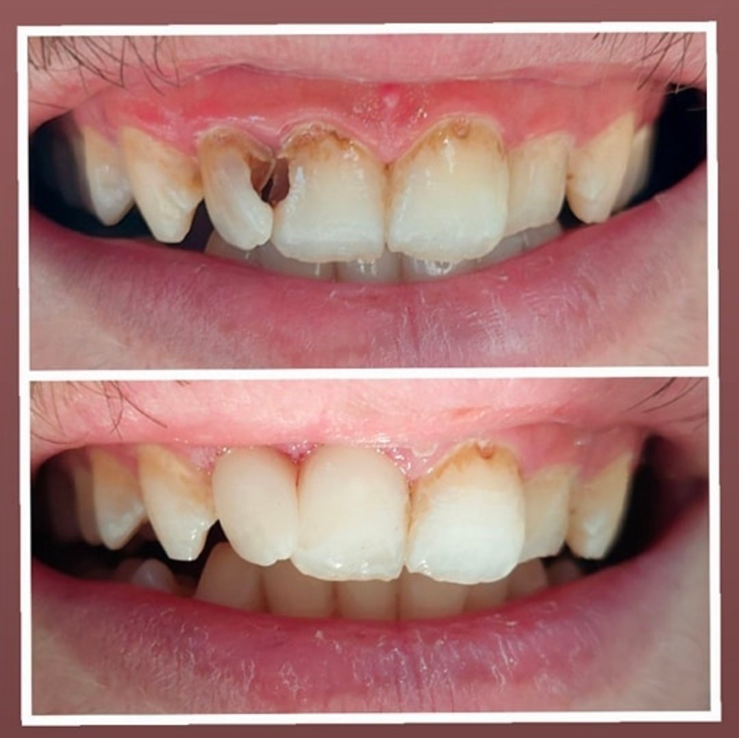 حشوة تجميلية | Compsite filling